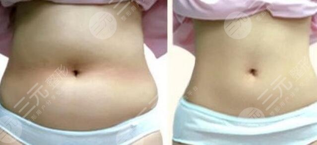 減肥塑型手術(shù)優(yōu)勢