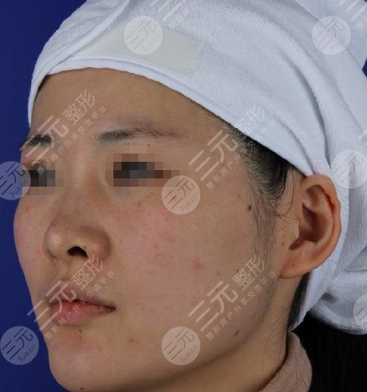 光子嫩膚果對比照片