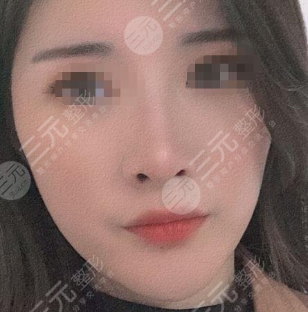 光子嫩膚果對比照片