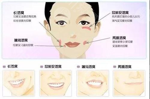 酒窩手術(shù)的原理