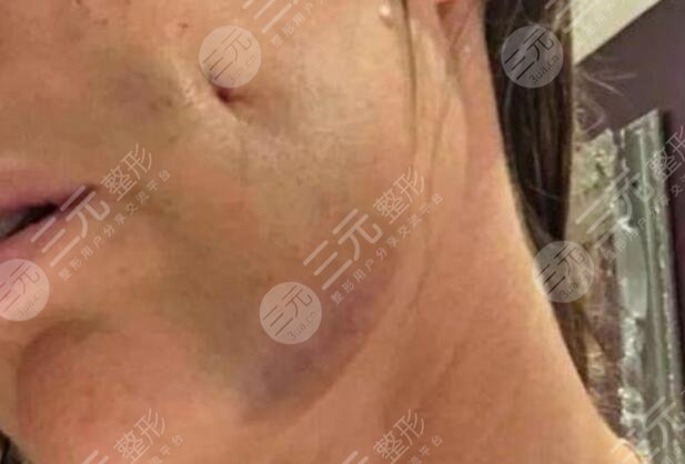 酒窩形態(tài)不自然