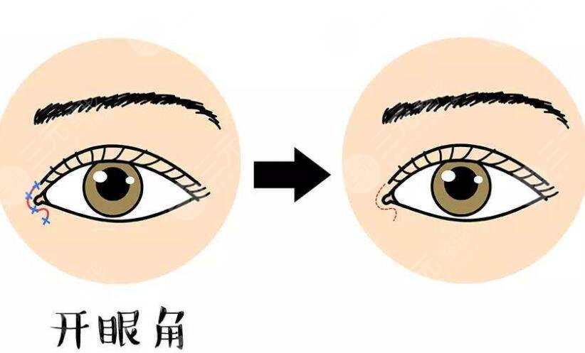 10個(gè)開眼角9個(gè)留疤是真的嗎？如何避免開眼角留疤？