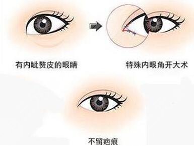 10個(gè)開眼角9個(gè)留疤是真的嗎？