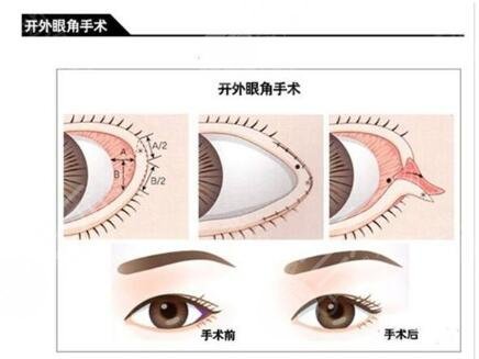 開外眼角