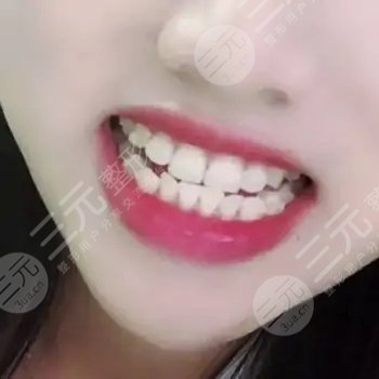 美容冠真實(shí)圖片