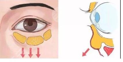 怎樣加快眼袋恢復(fù)