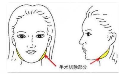 影響削骨瘦臉手術(shù)收費(fèi)的因素