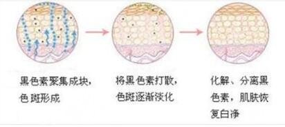 光子嫩膚的緩解原理