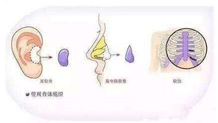 隆鼻手術(shù)的分類