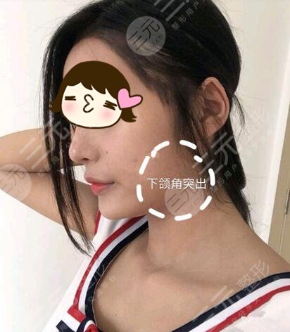 削骨瘦臉手術(shù)前需要了解了相關(guān)知識
