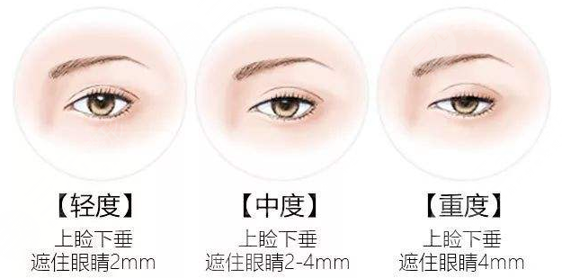 眼皮松弛怎么辦？愛美者一定要引起足夠的重視！