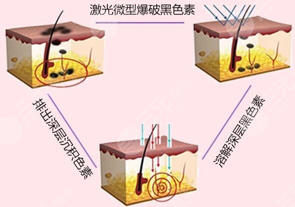 彩光去雀斑