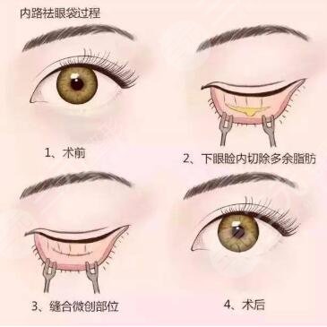 眼袋切除手術(shù)