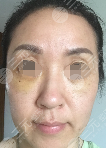 面部年輕化plus全臉，快速解決面部問題，內(nèi)附真實(shí)案例分享圖