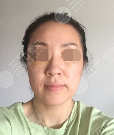 面部年輕化plus全臉，快速解決面部問題，內(nèi)附真實(shí)案例分享圖