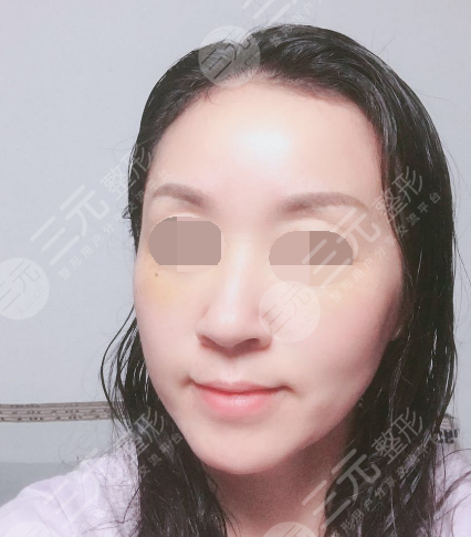 面部年輕化plus全臉，快速解決面部問題，內(nèi)附真實(shí)案例分享圖