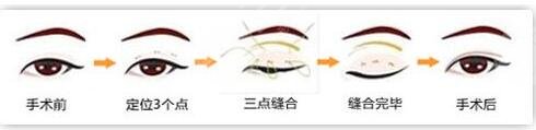 韓式微創(chuàng)雙眼皮維持時(shí)間