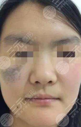 北海市人民醫(yī)院去太田痣案例