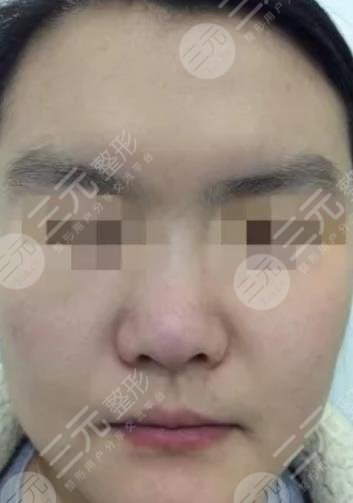 北海市人民醫(yī)院去太田痣案例