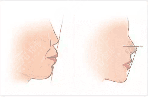 齙牙怎么矯正？如何解決齙牙這個問題，成為了他們的重中之重