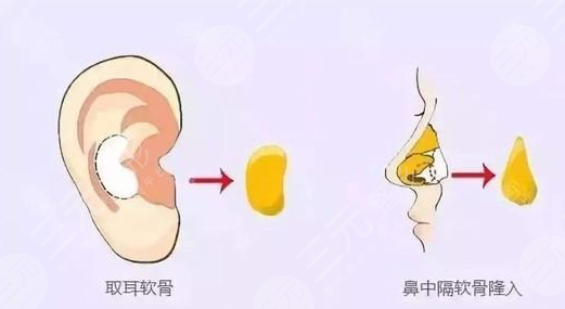 自體軟骨隆鼻