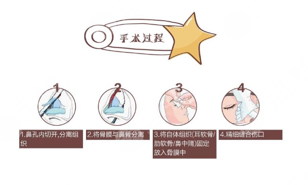 自體軟骨隆鼻手術(shù)