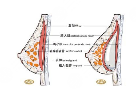 曼托假體隆胸