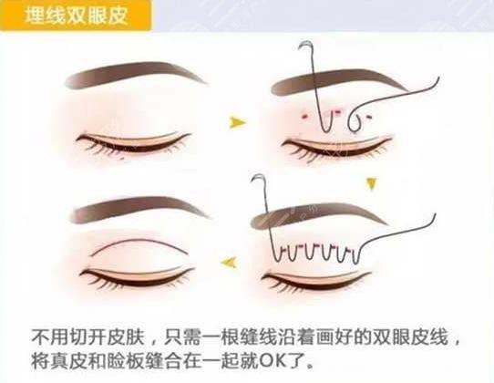 埋線雙眼皮一到7天圖片分享，附埋線雙眼皮恢復(fù)圖片過(guò)程