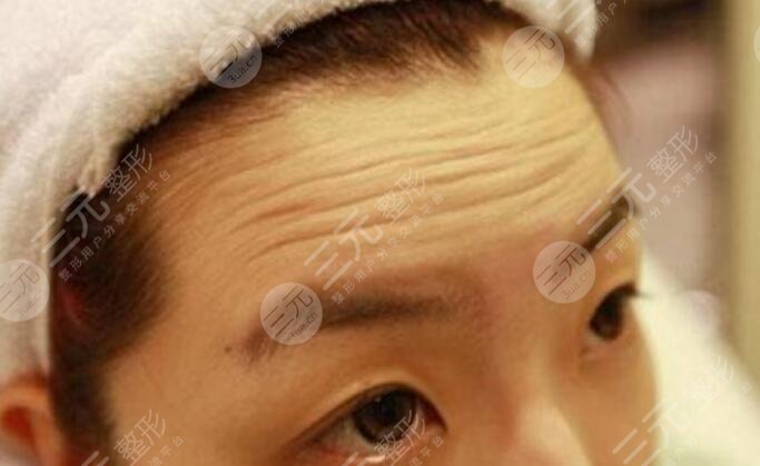去抬頭紋大概要多少錢？深知4個原因影響了手術(shù)的價格！