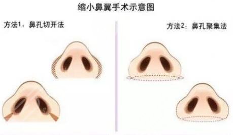 什么是鼻頭縮小術