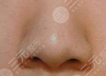 鼻頭縮小手術價錢具體是多少？