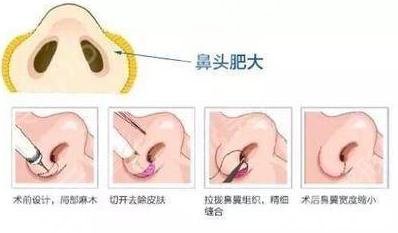 鼻頭縮小能保持多久