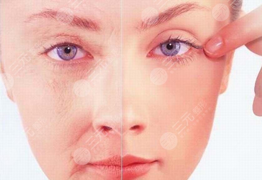 像素激光除皺怎么樣
