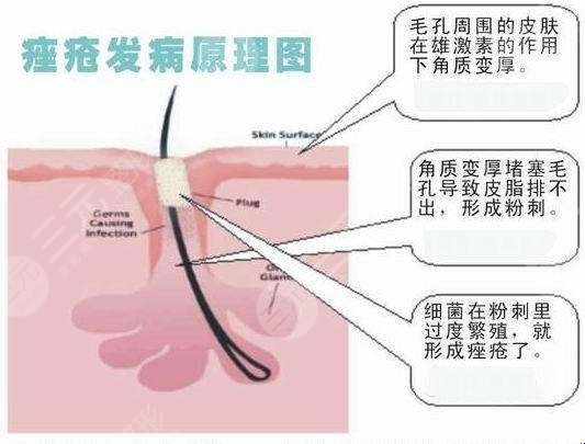 顴骨長痘怎么辦