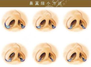 鼻翼縮小手術(shù)應遵循什么原則