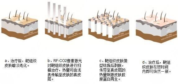 像素激光