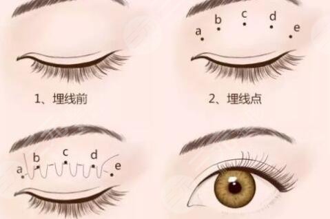 埋線法