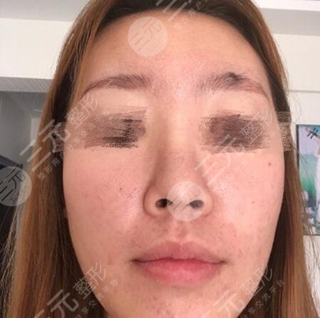 上海九院王煒做鼻子怎么樣