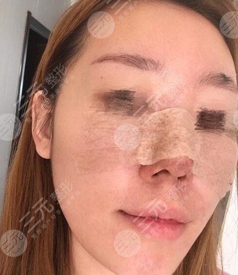 上海九院王煒做鼻子怎么樣