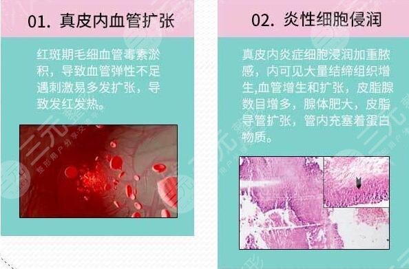 酒糟鼻
