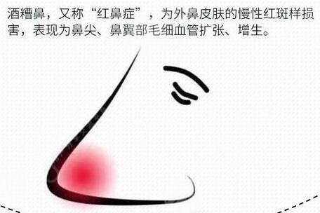 酒糟鼻整形