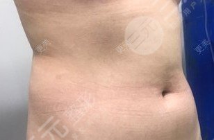 廣美整形美容醫(yī)院腰腹吸脂案例