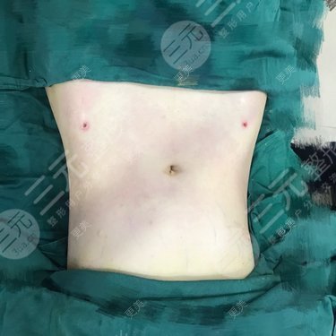 廣美整形美容醫(yī)院腰腹吸脂案例