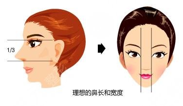 自體軟骨移植隆鼻術(shù)