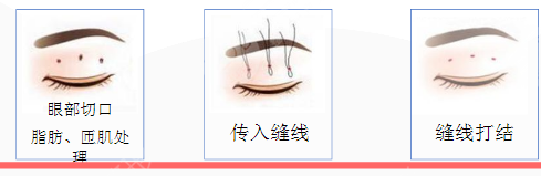 三點(diǎn)定位雙眼皮