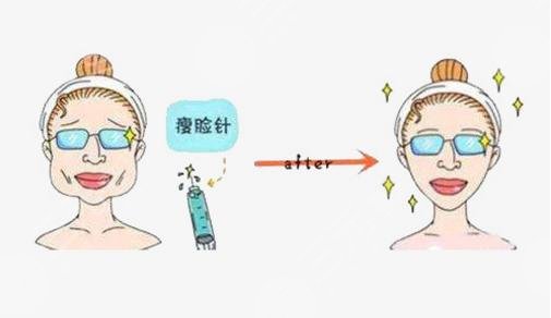 咬肌瘦臉?lè)N類(lèi)