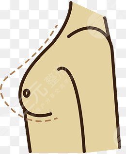 乳房懸吊圖片前后對(duì)比圖，術(shù)后一個(gè)月果反饋~