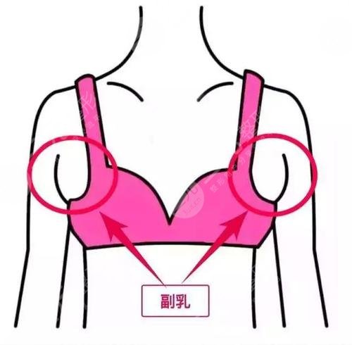 副乳切除手術(shù)幾天恢復(fù)