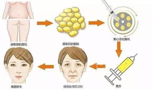 脂肪填充太陽凹陷能維持多久