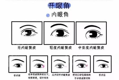 開內(nèi)眼角